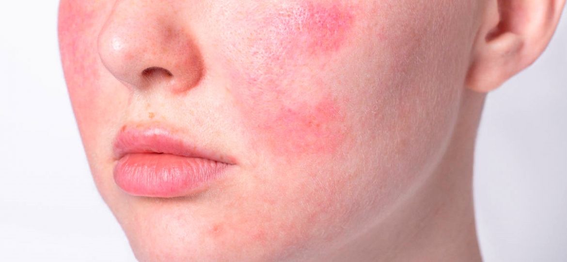 Rosacea